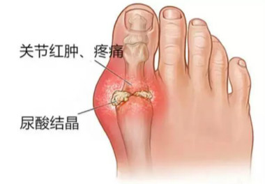 痛风对身体的危害.jpg 痛风对身体的危害.jpg