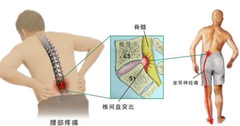 腰间盘突出1.jpg 腰间盘突出1.jpg