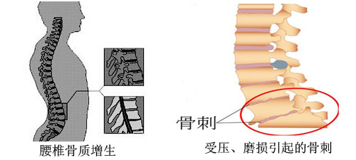 骨质增生常见症状.jpg 骨质增生常见症状.jpg