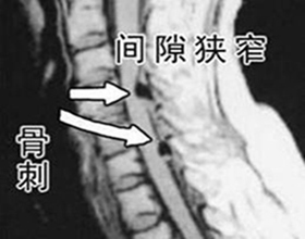 骨质增生治疗误区.jpg 骨质增生治疗误区.jpg