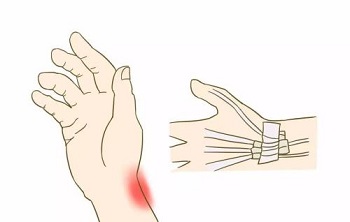 腱鞘炎6.jpg 腱鞘炎6.jpg