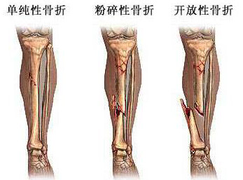 骨折病因.jpg 骨折病因.jpg